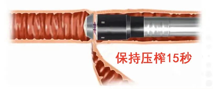 吻合器怎么用柳叶邂逅 ｜ 吻合器专题一：一次性使用管形吻合器操作要点_https://www.jmylbn.com_新闻资讯_第9张