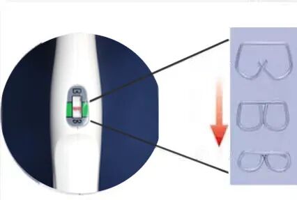 吻合器怎么用柳叶邂逅 ｜ 吻合器专题一：一次性使用管形吻合器操作要点_https://www.jmylbn.com_新闻资讯_第8张