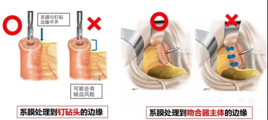 吻合器怎么用柳叶邂逅 ｜ 吻合器专题一：一次性使用管形吻合器操作要点_https://www.jmylbn.com_新闻资讯_第5张