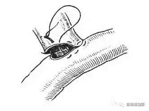 为什么要用皮钉缝合【经验分享】外科缝合法大全_https://www.jmylbn.com_新闻资讯_第14张