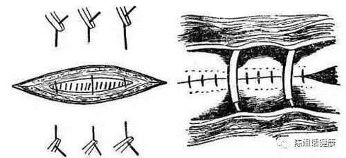 为什么要用皮钉缝合【经验分享】外科缝合法大全_https://www.jmylbn.com_新闻资讯_第15张