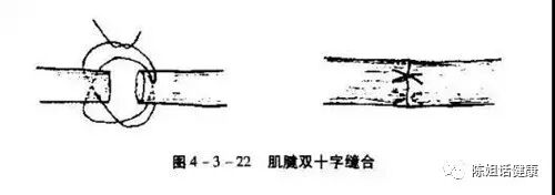 为什么要用皮钉缝合【经验分享】外科缝合法大全_https://www.jmylbn.com_新闻资讯_第19张
