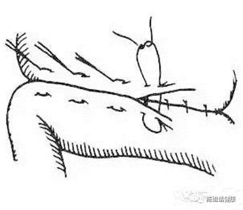 为什么要用皮钉缝合【经验分享】外科缝合法大全_https://www.jmylbn.com_新闻资讯_第7张