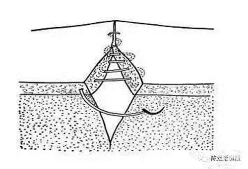为什么要用皮钉缝合【经验分享】外科缝合法大全_https://www.jmylbn.com_新闻资讯_第17张