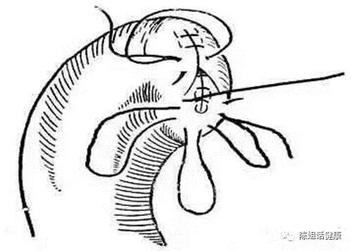 为什么要用皮钉缝合【经验分享】外科缝合法大全_https://www.jmylbn.com_新闻资讯_第11张