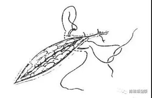 为什么要用皮钉缝合【经验分享】外科缝合法大全_https://www.jmylbn.com_新闻资讯_第12张