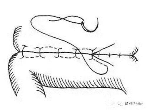 为什么要用皮钉缝合【经验分享】外科缝合法大全_https://www.jmylbn.com_新闻资讯_第8张