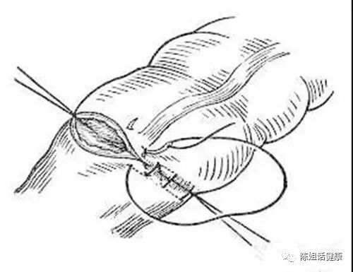 为什么要用皮钉缝合【经验分享】外科缝合法大全_https://www.jmylbn.com_新闻资讯_第9张
