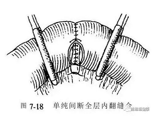为什么要用皮钉缝合【经验分享】外科缝合法大全_https://www.jmylbn.com_新闻资讯_第5张