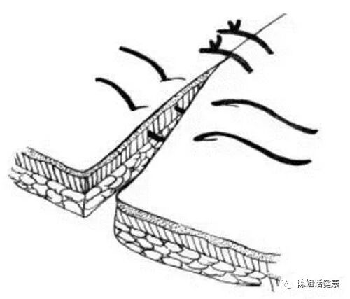 为什么要用皮钉缝合【经验分享】外科缝合法大全_https://www.jmylbn.com_新闻资讯_第2张