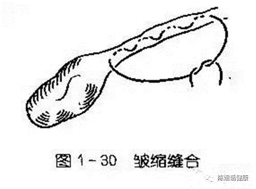 为什么要用皮钉缝合【经验分享】外科缝合法大全_https://www.jmylbn.com_新闻资讯_第18张