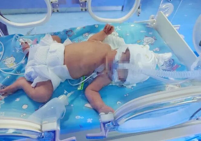 无创辅助通气是什么无创通气技术——新生儿急危重症抢救的重要手段_https://www.jmylbn.com_新闻资讯_第4张