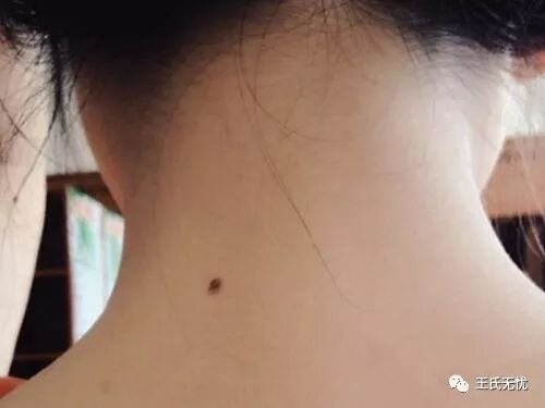 美女抠掉身上的痣几天后 感觉不对劲 医生的话让她吓得腿软 王氏无忧 微信公众号文章阅读 Wemp