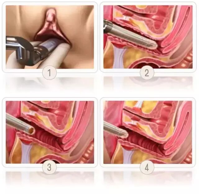 妇科脉冲怎么回事【激光科普】超脉冲CO2激光治疗阴道松弛_https://www.jmylbn.com_新闻资讯_第5张