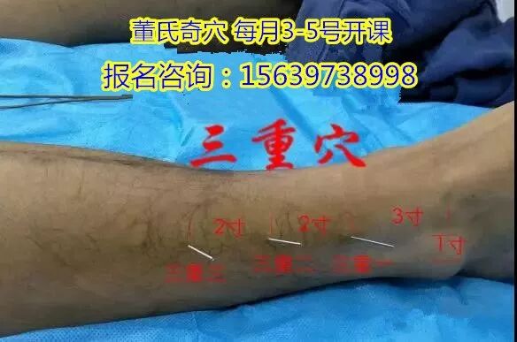 董氏奇穴u2014u2014扁桃腺炎处方、咳嗽处方- 医技交流 微信公众号文章阅读- WeMP