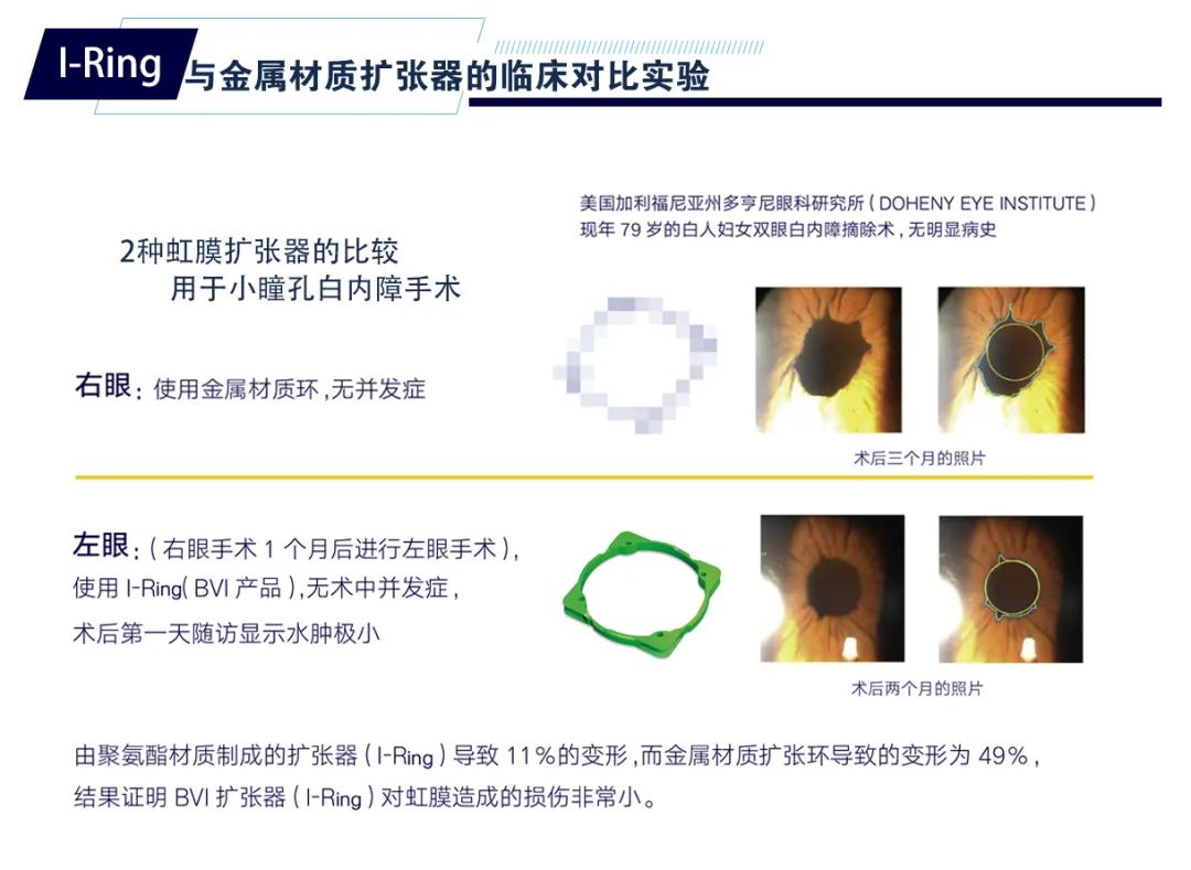 Visitec® I-Ring®为小瞳孔白内障患者提供最佳术后视力恢复