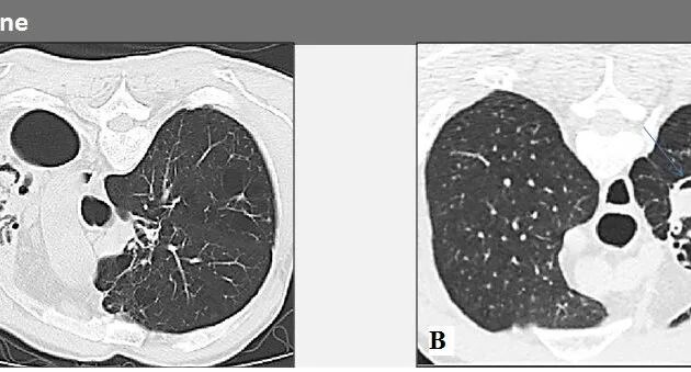 abp在医学是什么意思如何区分4种类型的肺曲霉菌病影像学表现？_https://www.jmylbn.com_新闻资讯_第3张