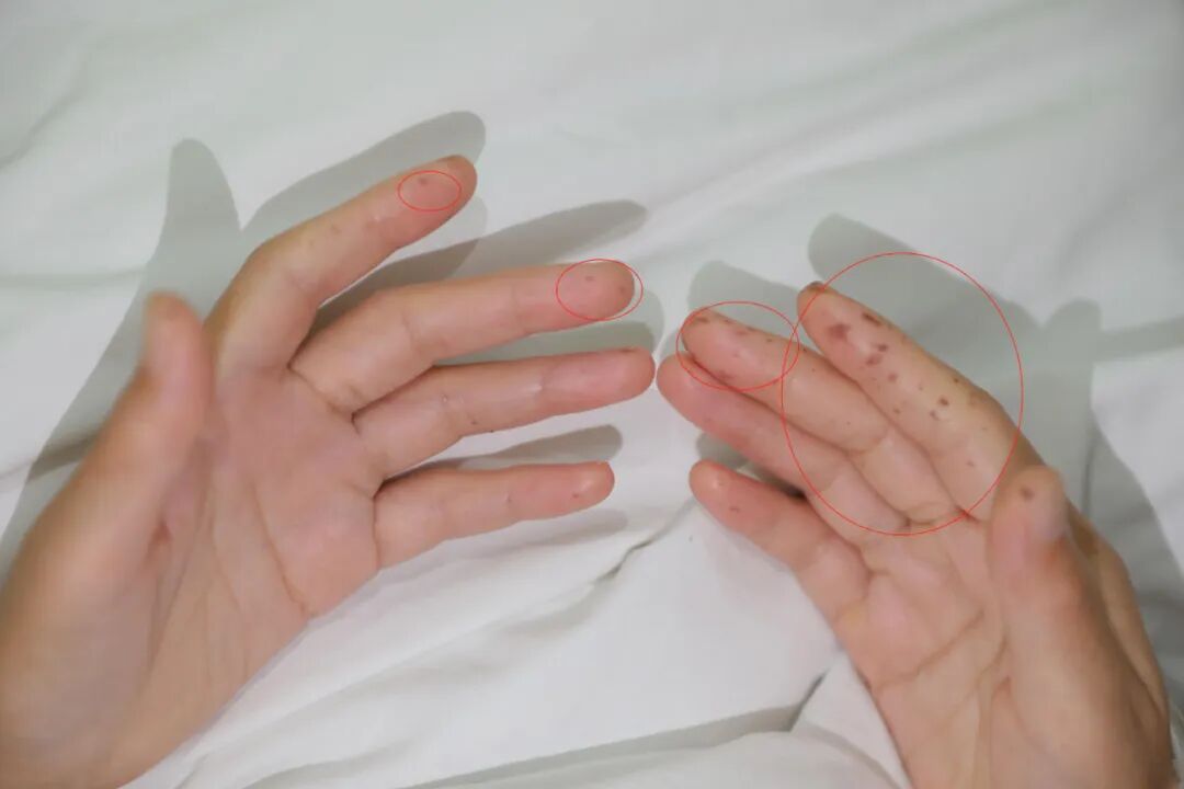 手术拉链怎么拆前沿突破 ｜ 中山医院内镜团队再闯禁区，巧用小肠镜切除巨大息肉，解除“拉链腹”患者肠套叠之苦_https://www.jmylbn.com_新闻资讯_第3张