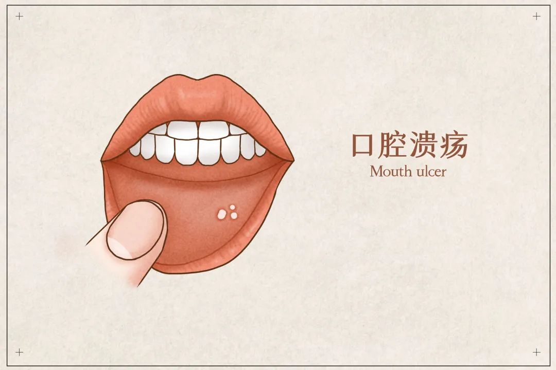 快速缓解口腔溃疡方法+实用预防技巧，助你告别疼痛困扰！