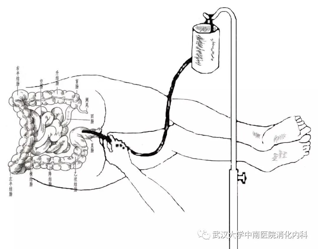 吸痰用什么手套药物保留灌肠的操作流程与注意事项-上海聚慕医疗器械有限公司