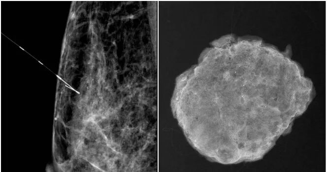 为什么要定位针 乳腺发现钙化灶怎么办？乳腺钼靶精准定位，针尖所指病灶现形_https://www.jmylbn.com_新闻资讯_第2张