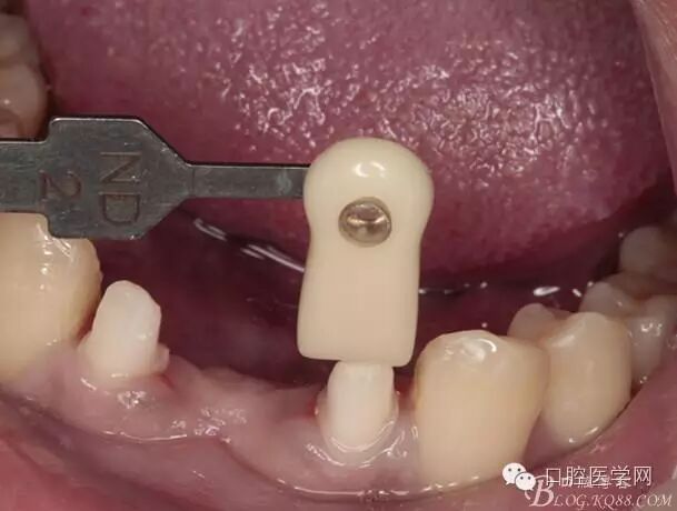 三例下前牙冠修复的回顾与反思