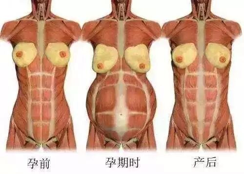 为什么产后肚子还是鼓鼓的！腹直肌分离了解多少？