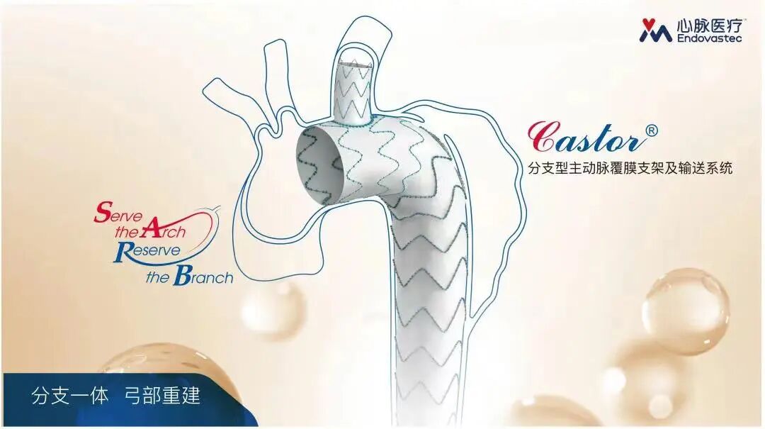 治疗车怎么推「弓部重建直通车」鄂尔多斯市中心医院康巴什部介入科运用Castor®分支型支架联合预开窗技术治疗Stanford B型胸主动夹层_https://www.jmylbn.com_新闻资讯_第12张