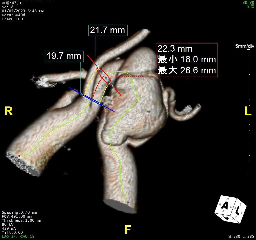 gore医疗怎么样「胸有乾坤」化险为夷，通险畅机——GORE® TAG® 胸主动脉覆膜支架治疗累及异形弓部动脉瘤_https://www.jmylbn.com_新闻资讯_第10张