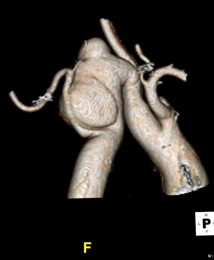 gore医疗怎么样「胸有乾坤」化险为夷，通险畅机——GORE® TAG® 胸主动脉覆膜支架治疗累及异形弓部动脉瘤_https://www.jmylbn.com_新闻资讯_第12张