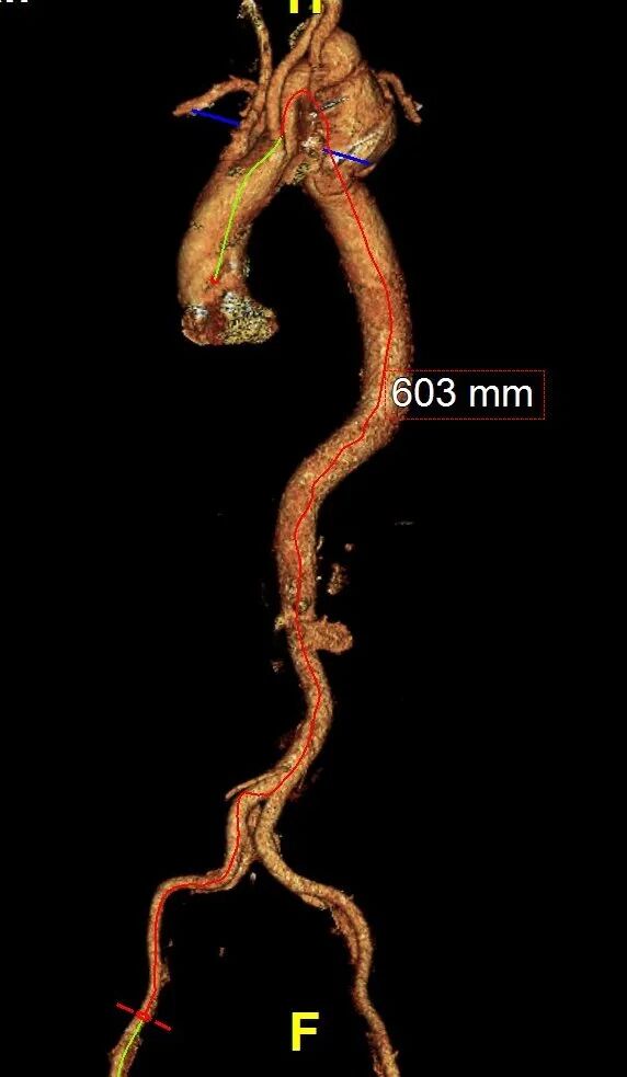 gore医疗怎么样「胸有乾坤」化险为夷，通险畅机——GORE® TAG® 胸主动脉覆膜支架治疗累及异形弓部动脉瘤_https://www.jmylbn.com_新闻资讯_第9张