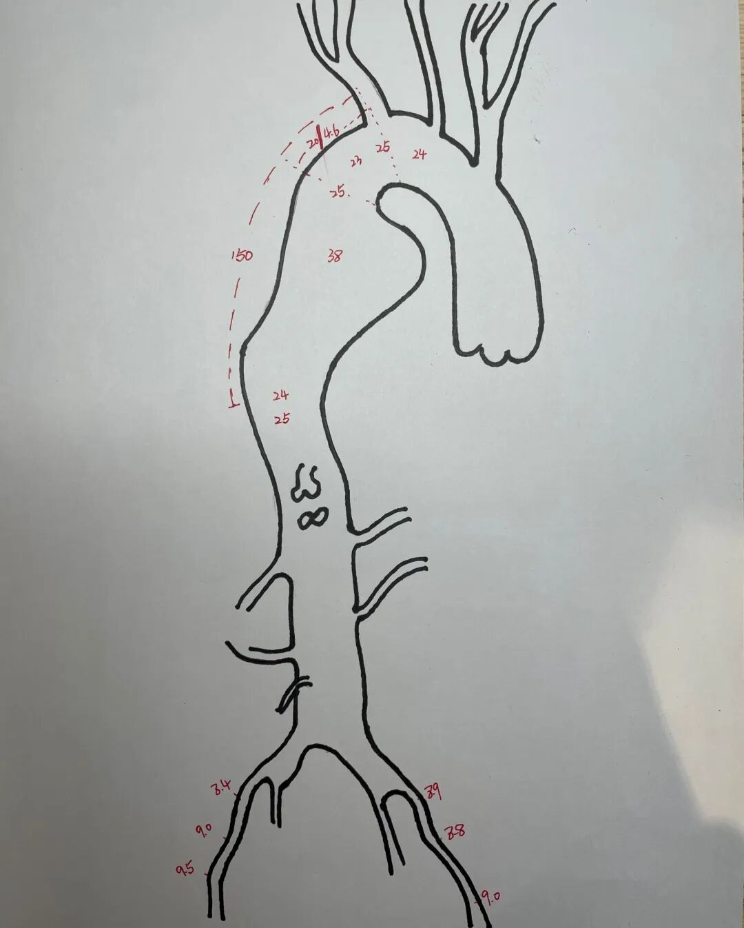 gore医疗怎么样「胸有乾坤」可调可控，从容不迫——GORE® TAG®可主动调控胸主动脉覆膜支架治疗右弓右降伴Kommerell憩室病例_https://www.jmylbn.com_新闻资讯_第11张