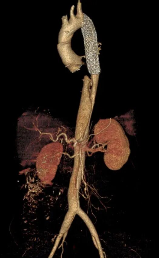 gore医疗怎么样「胸有乾坤」可调可控 分毫必争—GORE®TAG® 可主动调控胸主动脉覆膜支架治疗B型主动脉夹层伴升主动脉瘤病例报道_https://www.jmylbn.com_新闻资讯_第16张