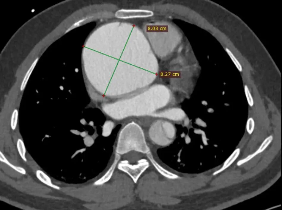 gore医疗怎么样「胸有乾坤」可调可控 分毫必争—GORE®TAG® 可主动调控胸主动脉覆膜支架治疗B型主动脉夹层伴升主动脉瘤病例报道_https://www.jmylbn.com_新闻资讯_第7张