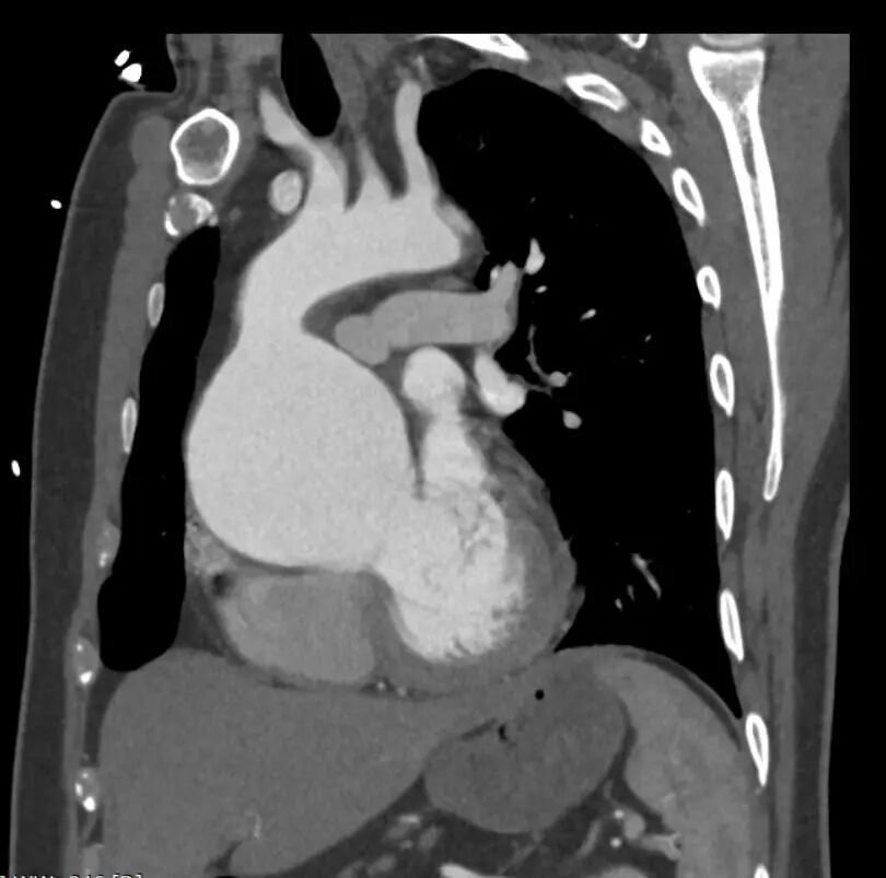 gore医疗怎么样「胸有乾坤」可调可控 分毫必争—GORE®TAG® 可主动调控胸主动脉覆膜支架治疗B型主动脉夹层伴升主动脉瘤病例报道_https://www.jmylbn.com_新闻资讯_第6张