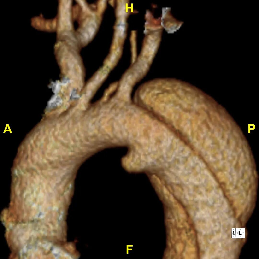 gore医疗怎么样「胸有乾坤」释半功倍 得心应手——GORE®TAG® 可主动调控胸主动脉覆膜支架治疗B型主动脉夹层病例分享 复旦大学附属中山医院_https://www.jmylbn.com_新闻资讯_第15张