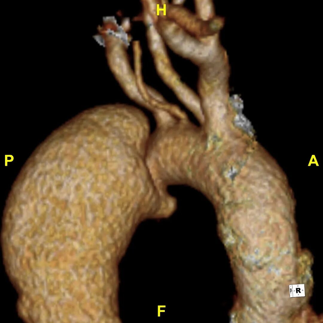 gore医疗怎么样「胸有乾坤」释半功倍 得心应手——GORE®TAG® 可主动调控胸主动脉覆膜支架治疗B型主动脉夹层病例分享 复旦大学附属中山医院_https://www.jmylbn.com_新闻资讯_第14张
