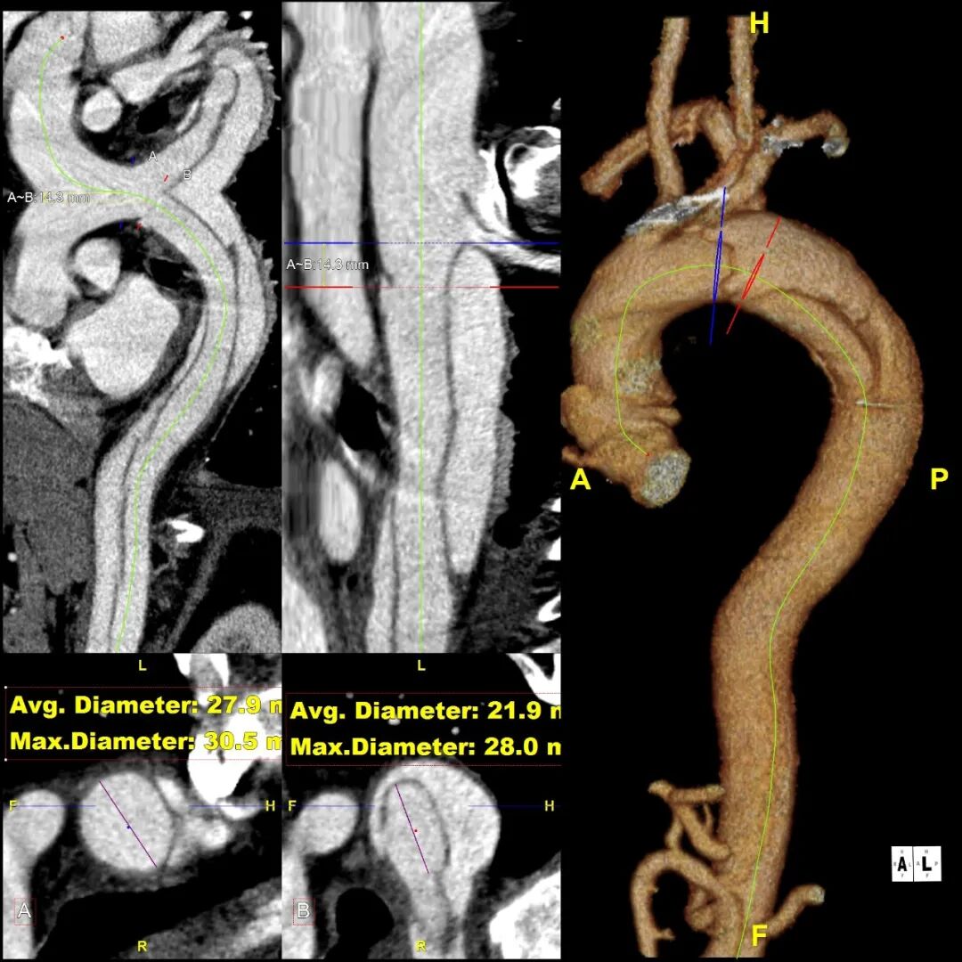 gore医疗怎么样「胸有乾坤」释半功倍 得心应手——GORE®TAG® 可主动调控胸主动脉覆膜支架治疗B型主动脉夹层病例分享 复旦大学附属中山医院_https://www.jmylbn.com_新闻资讯_第6张
