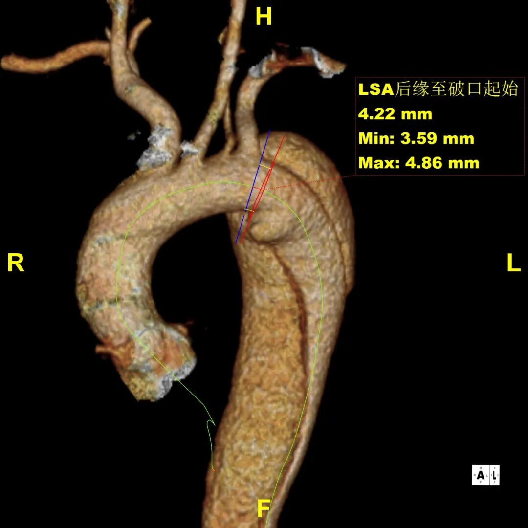 gore医疗怎么样「胸有乾坤」释半功倍 得心应手——GORE®TAG® 可主动调控胸主动脉覆膜支架治疗B型主动脉夹层病例分享 复旦大学附属中山医院_https://www.jmylbn.com_新闻资讯_第13张