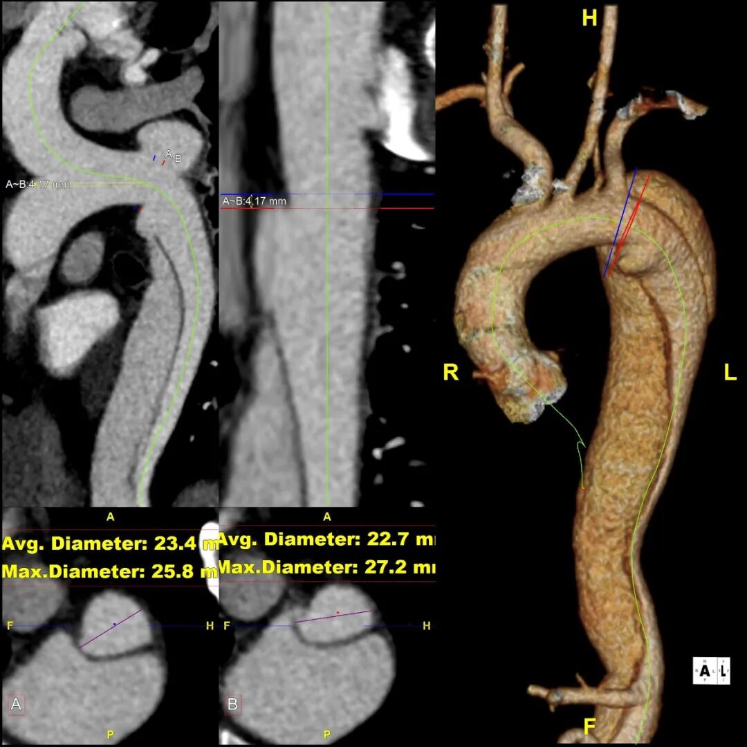 gore医疗怎么样「胸有乾坤」释半功倍 得心应手——GORE®TAG® 可主动调控胸主动脉覆膜支架治疗B型主动脉夹层病例分享 复旦大学附属中山医院_https://www.jmylbn.com_新闻资讯_第12张