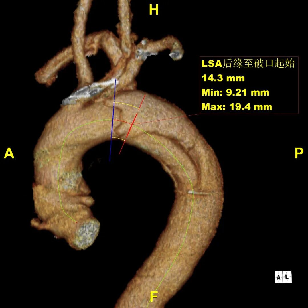 gore医疗怎么样「胸有乾坤」释半功倍 得心应手——GORE®TAG® 可主动调控胸主动脉覆膜支架治疗B型主动脉夹层病例分享 复旦大学附属中山医院_https://www.jmylbn.com_新闻资讯_第7张