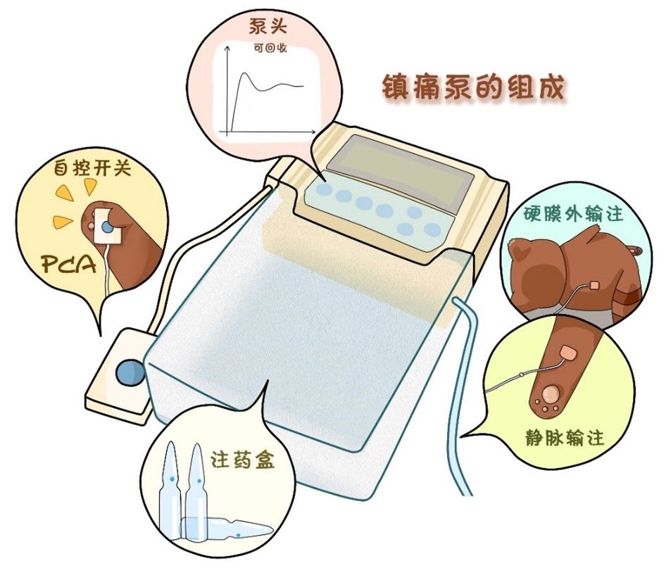 pca泵是什么【科普时间】手术后需要使用镇痛泵吗？_https://www.jmylbn.com_新闻资讯_第7张