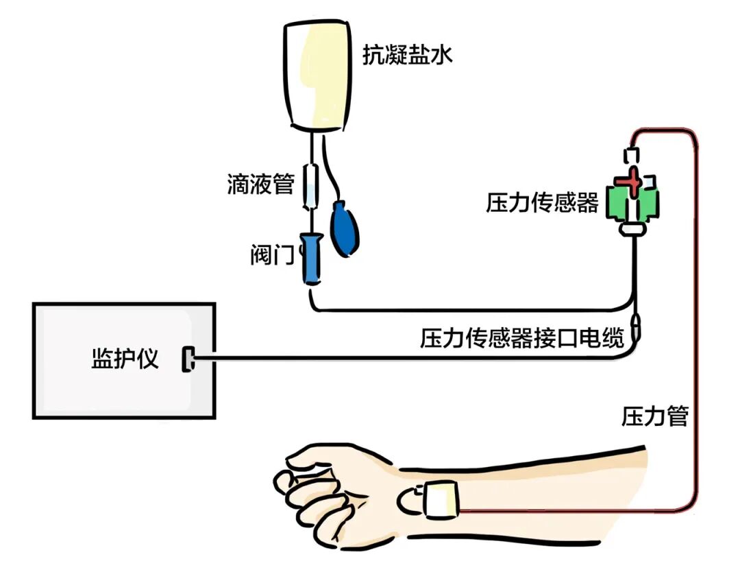 压力波是什么波有创动脉血压监测方法及波形解析_https://www.jmylbn.com_新闻资讯_第2张