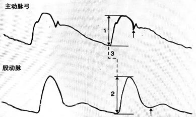 压力波是什么波有创动脉血压监测方法及波形解析_https://www.jmylbn.com_新闻资讯_第5张