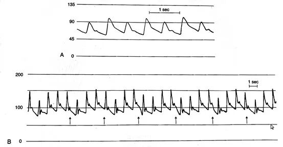 压力波是什么波有创动脉血压监测方法及波形解析_https://www.jmylbn.com_新闻资讯_第8张