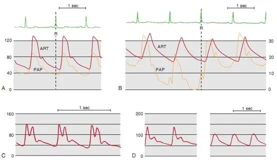 压力波是什么波有创动脉血压监测方法及波形解析_https://www.jmylbn.com_新闻资讯_第7张
