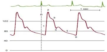 压力波是什么波有创动脉血压监测方法及波形解析_https://www.jmylbn.com_新闻资讯_第4张