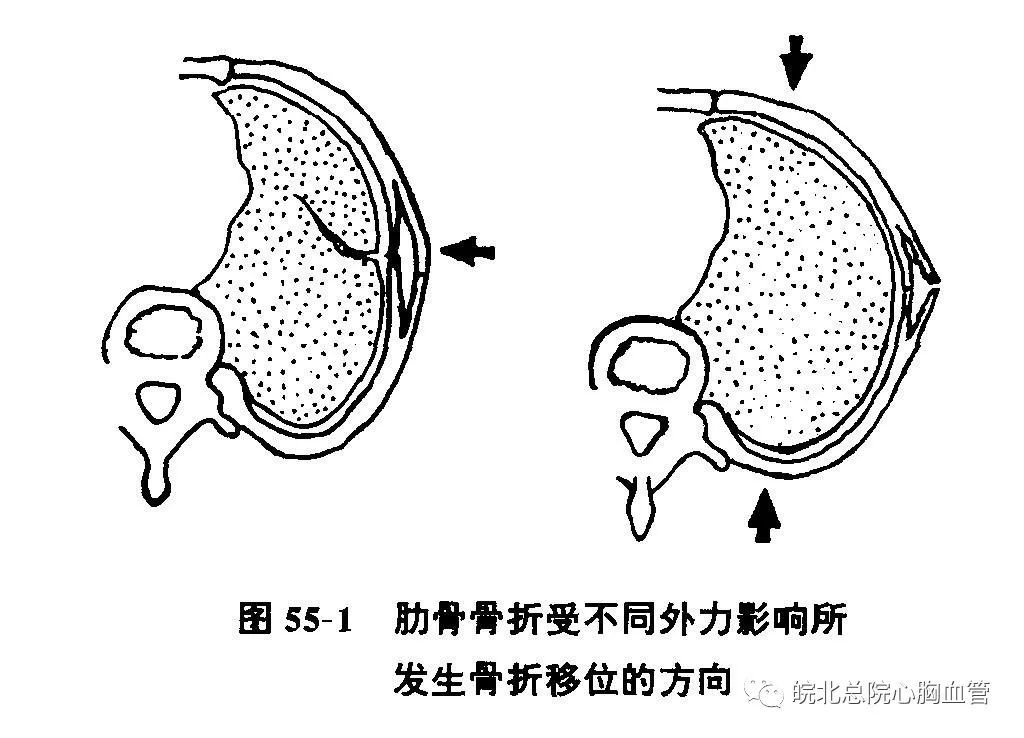直接暴力损伤一,都是哪些原因导致的肋骨骨折呢?