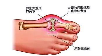 痛風到底有多可怕！這起死亡病例為所有人敲響警鐘 健康 第8張