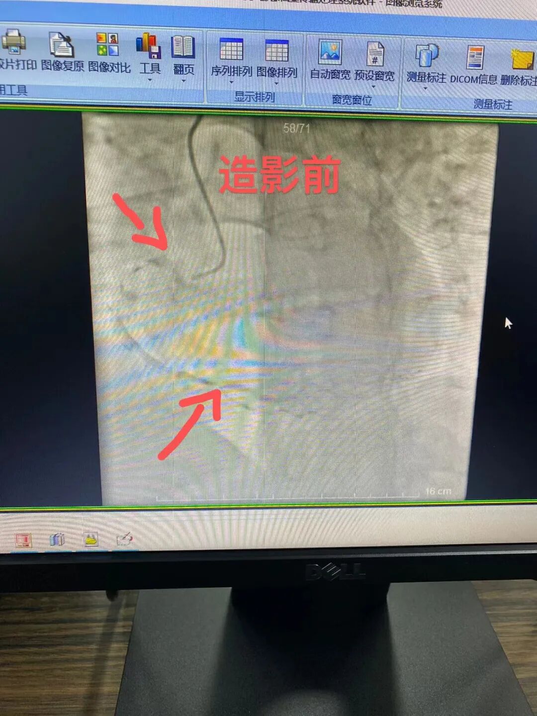 dsa是什么设备沭阳百姓的健康福音——国际高端设备西门子数字减影血管造影机（DSA）你了解多少？_https://www.jmylbn.com_新闻资讯_第13张
